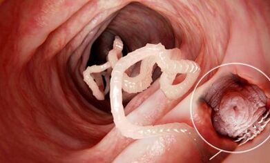 How to recognize the presence of parasites in the human bowels